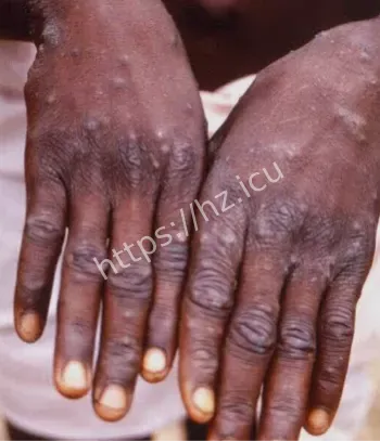 马达加斯加猴痘